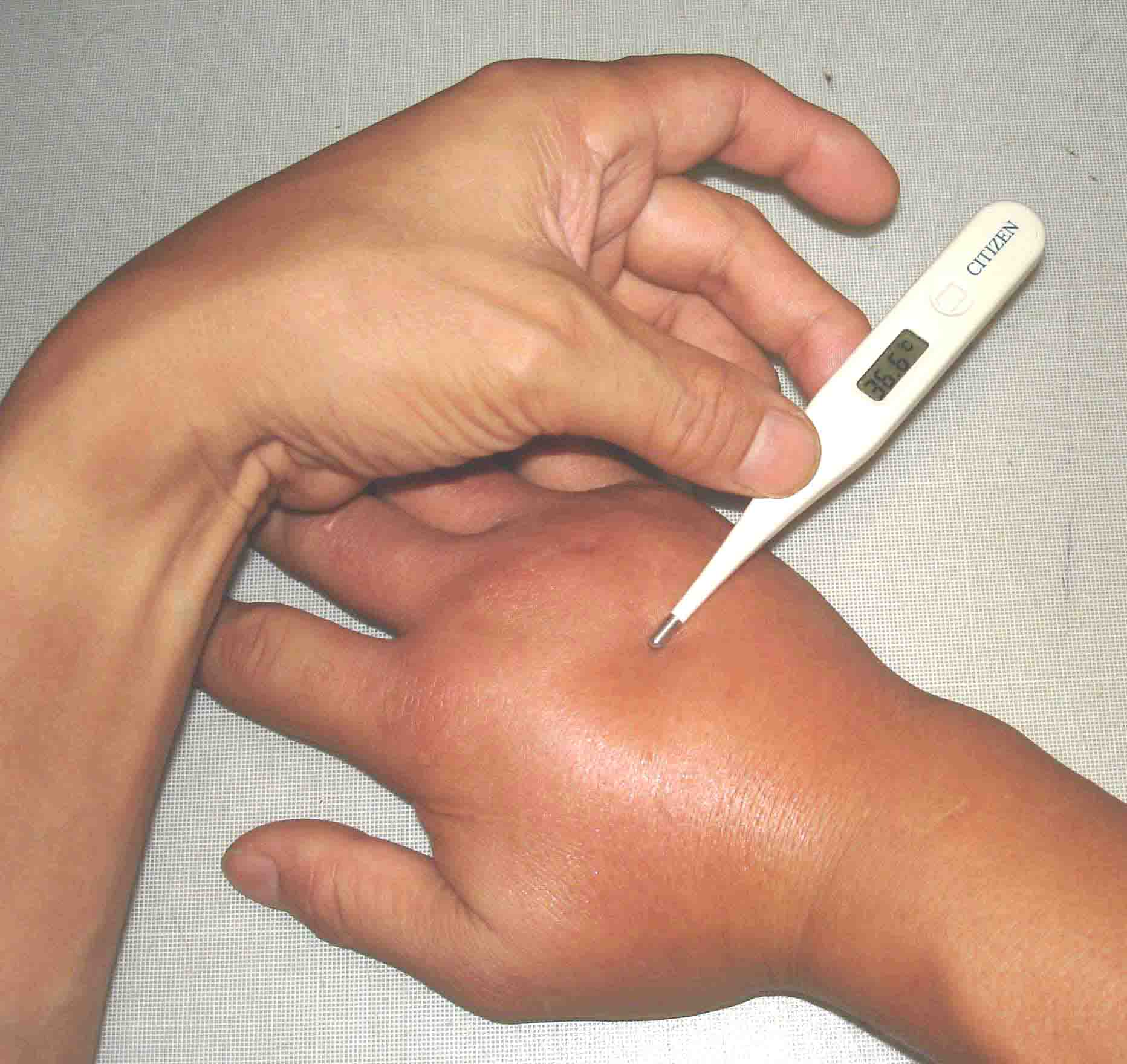 腫れた右手甲の温度測定（１７日１０：５６）
